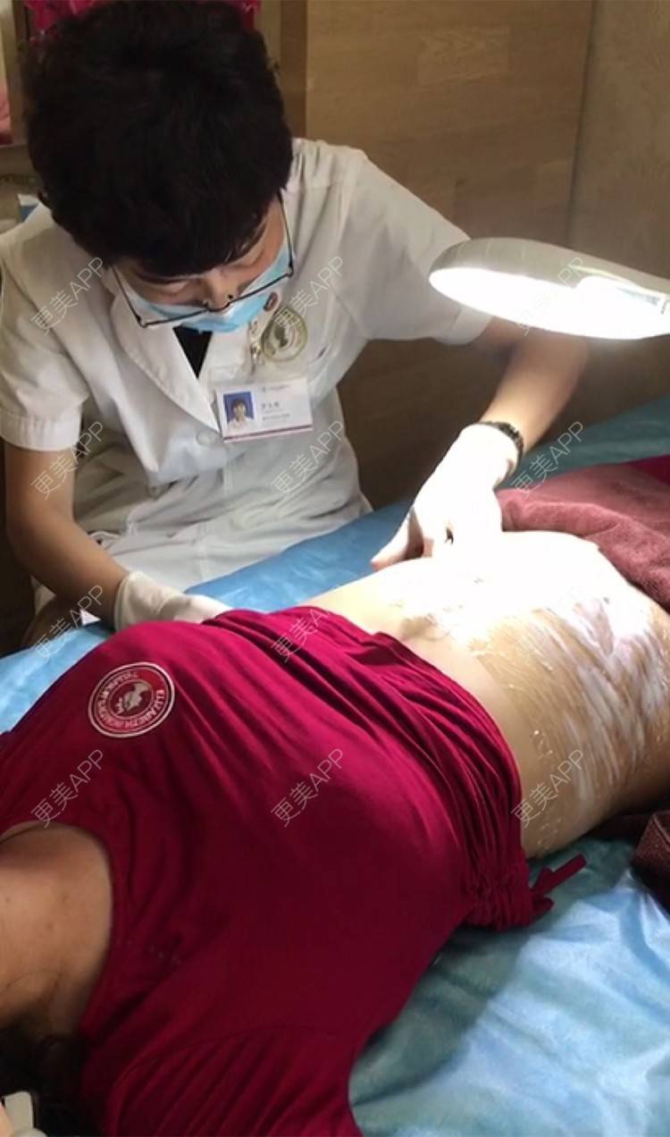 更美 - 思念是病o的激光淡化妊娠纹经验 | 广州 | 视频日记 | 激光淡化妊娠纹