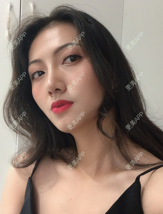 更美 - 雅致美的鼻中隔软骨隆鼻经验 | 鼻中隔软骨隆鼻