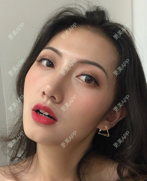 更美 - 雅致美的鼻中隔软骨隆鼻经验 | 鼻中隔软骨隆鼻