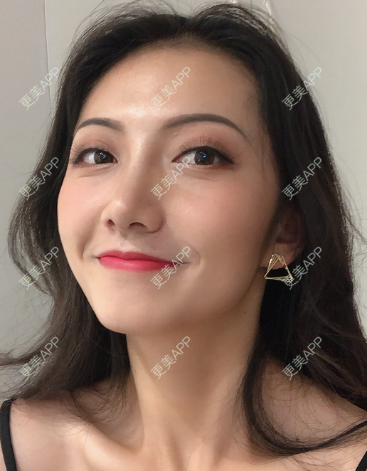 更美 - 雅致美的鼻中隔软骨隆鼻经验 | 鼻中隔软骨隆鼻