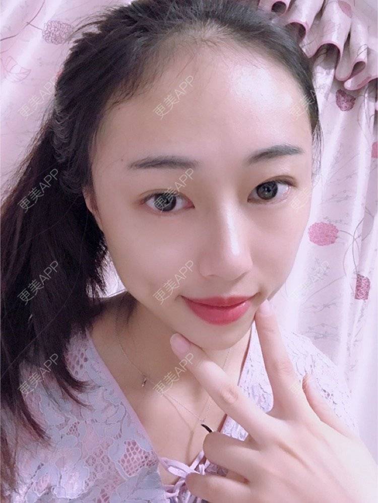 更美 - nininikkkk的玻尿酸苹果肌经验 | 玻尿酸太阳穴 | 深圳 | 玻尿酸苹果肌