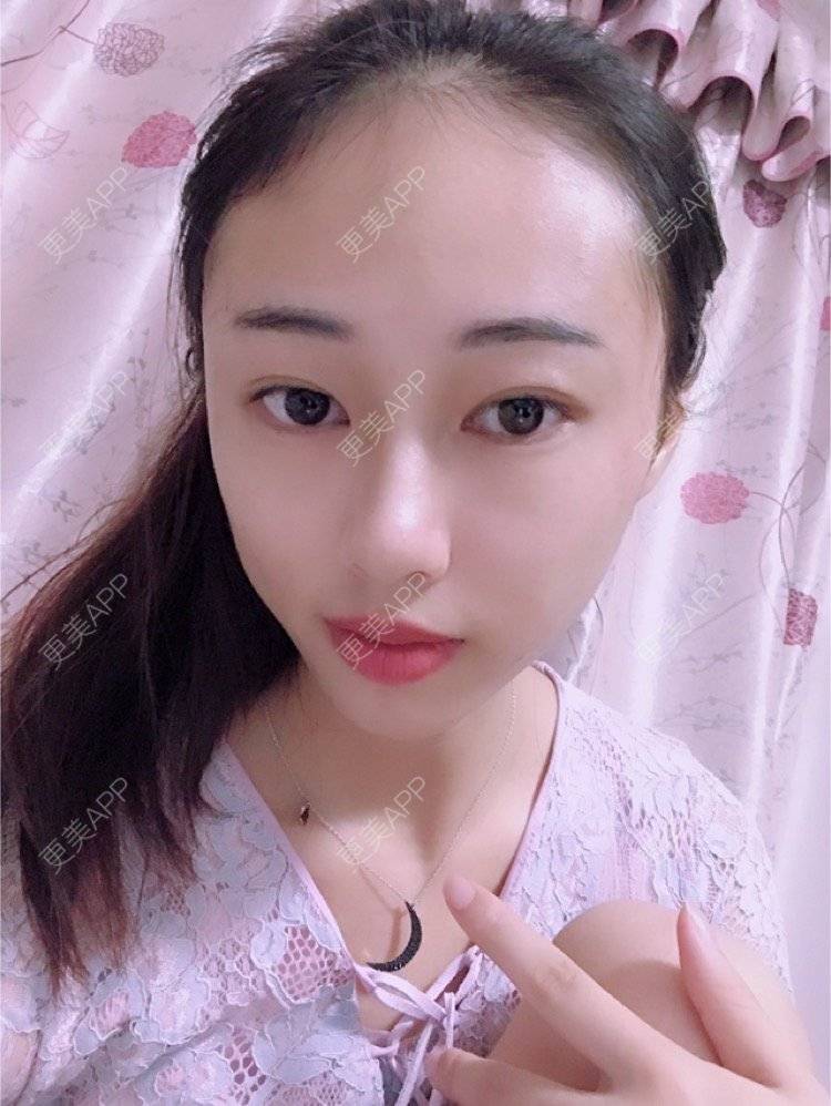 更美 - nininikkkk的玻尿酸苹果肌经验 | 玻尿酸太阳穴 | 深圳 | 玻尿酸苹果肌