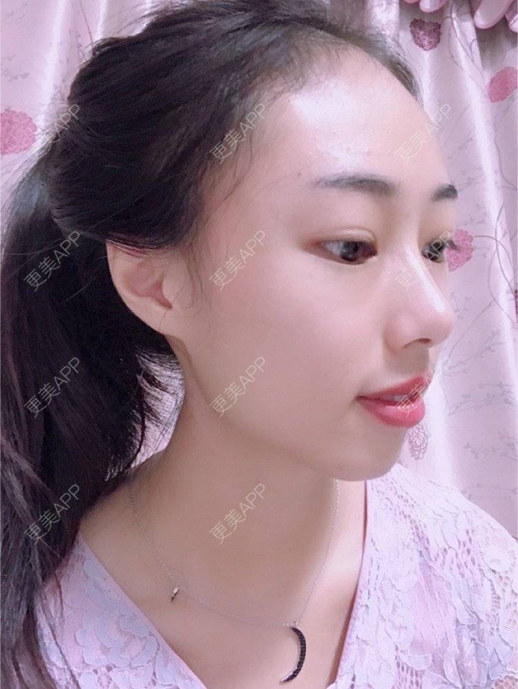 更美 - nininikkkk的玻尿酸苹果肌经验 | 玻尿酸太阳穴 | 深圳 | 玻尿酸苹果肌