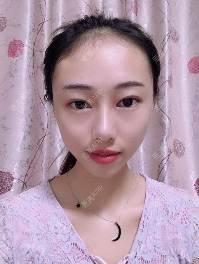 更美 - nininikkkk的玻尿酸苹果肌经验 | 玻尿酸太阳穴 | 深圳 | 玻尿酸苹果肌