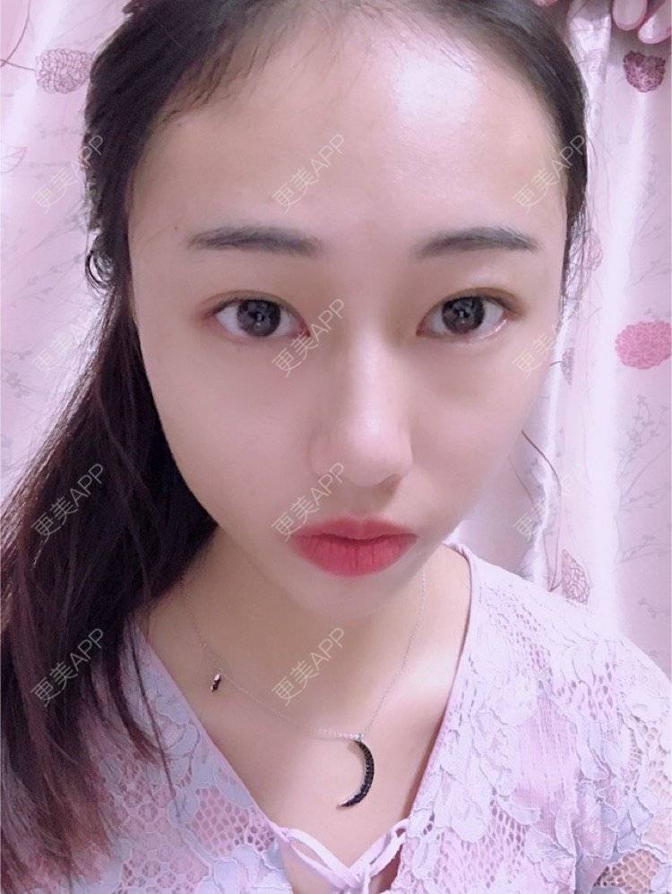 更美 - nininikkkk的玻尿酸苹果肌经验 | 玻尿酸太阳穴 | 深圳 | 玻尿酸苹果肌