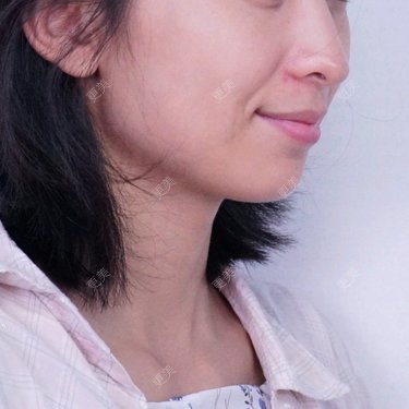 颧弓降低