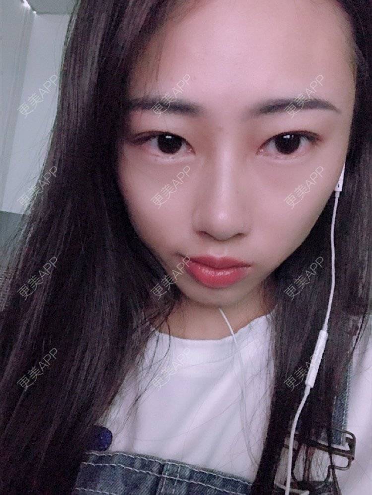 更美 - nininikkkk的玻尿酸苹果肌经验 | 深圳 | 玻尿酸苹果肌 | 玻尿酸太阳穴