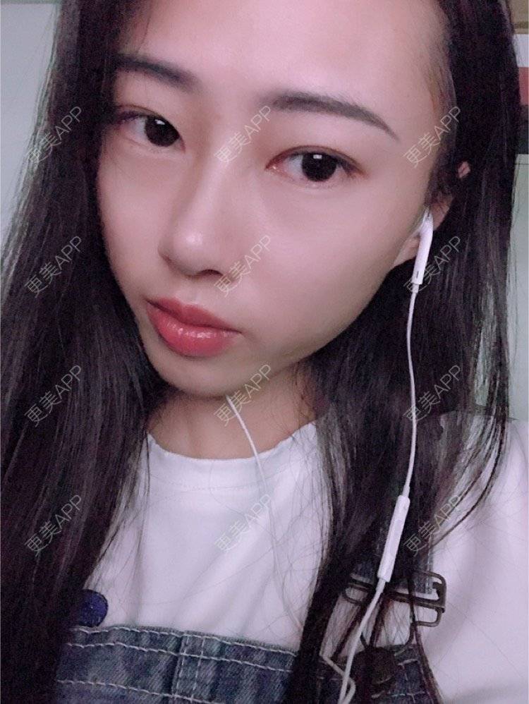 更美 - nininikkkk的玻尿酸苹果肌经验 | 深圳 | 玻尿酸苹果肌 | 玻尿酸太阳穴