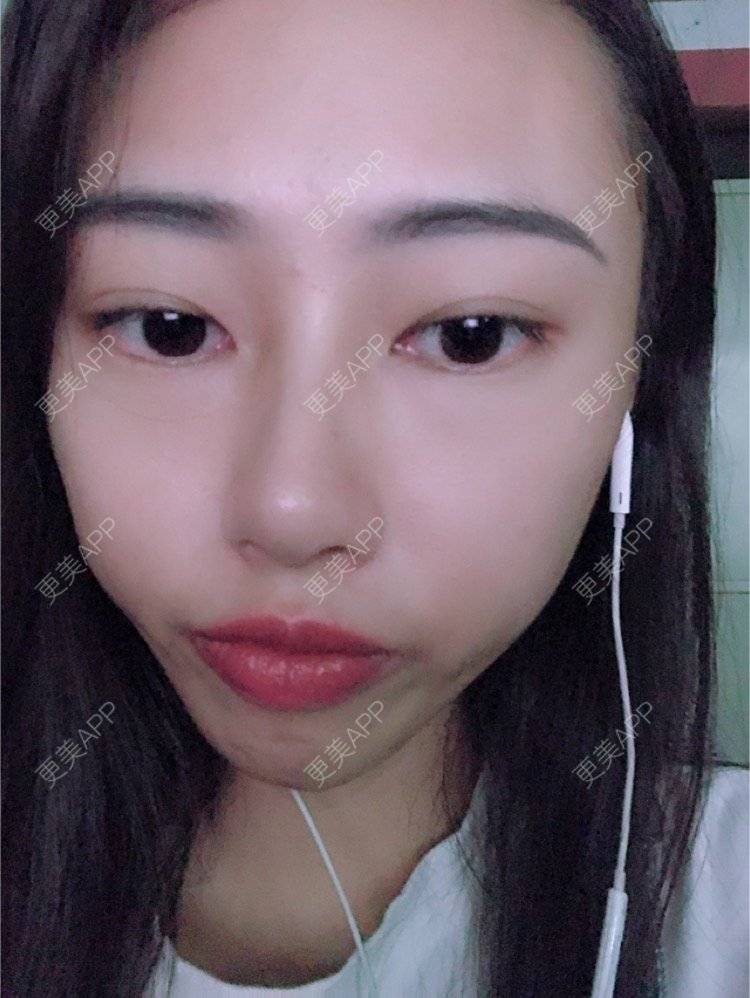 更美 - nininikkkk的玻尿酸苹果肌经验 | 深圳 | 玻尿酸苹果肌 | 玻尿酸太阳穴