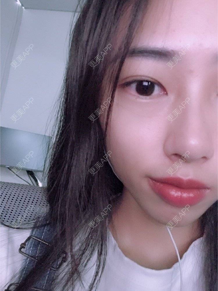 更美 - nininikkkk的玻尿酸苹果肌经验 | 深圳 | 玻尿酸苹果肌 | 玻尿酸太阳穴