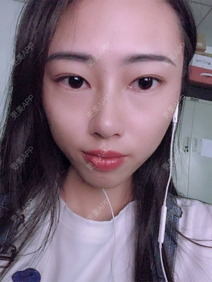 更美 - nininikkkk的玻尿酸苹果肌经验 | 深圳 | 玻尿酸苹果肌 | 玻尿酸太阳穴