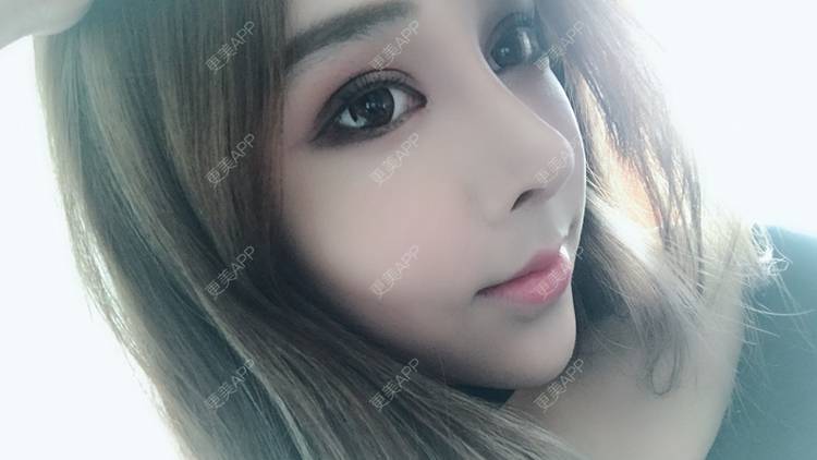 更美 - 小精玲的玻尿酸唇部经验 | 玻尿酸唇部 | 深圳