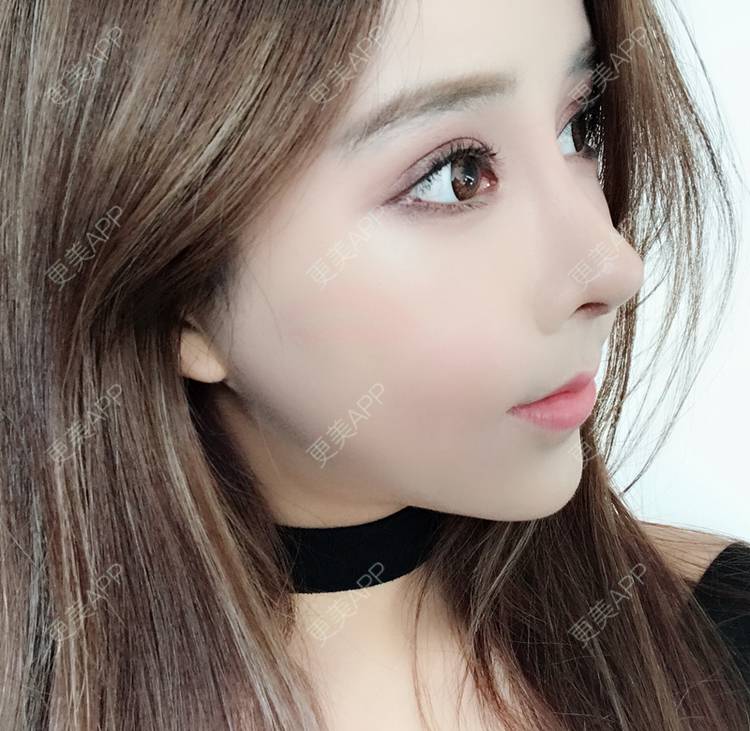 更美 - 小精玲的玻尿酸唇部经验 | 玻尿酸唇部 | 深圳