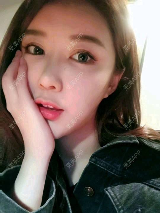 更美 - 旧事隔离的玻尿酸耳垂经验 | 玻尿酸耳垂