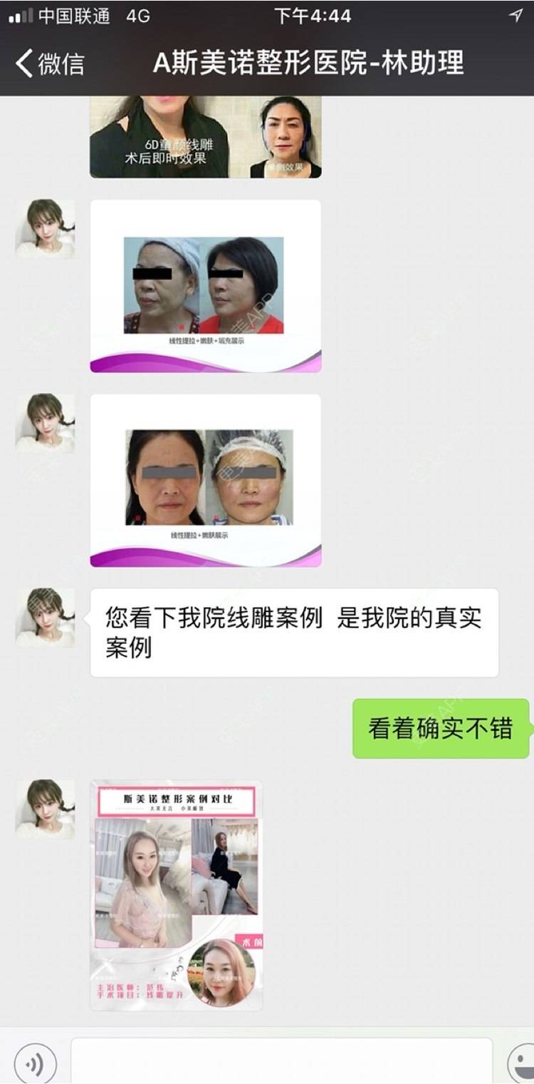 更美 - 更美用户SGWuwusOg1的埋线提升经验 | 祛斑祛色素 | 埋线提升 | 红蓝光清痘 | 自体脂肪隆胸 | 鼻部多项 | 玻尿酸 | 哈尔滨
