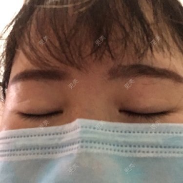 眼部修复