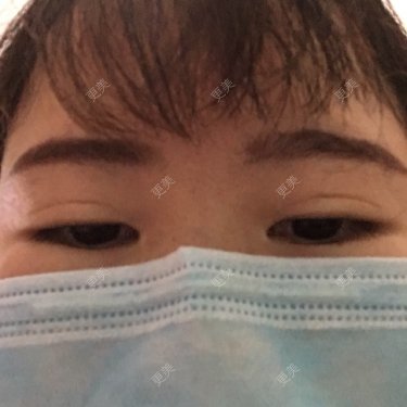 眼部修复