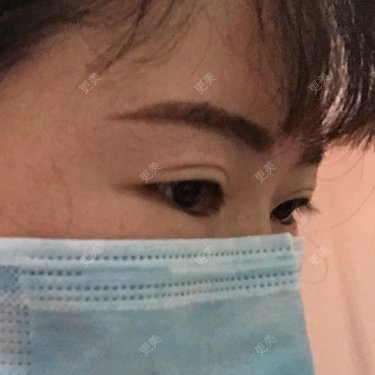 眼部修复