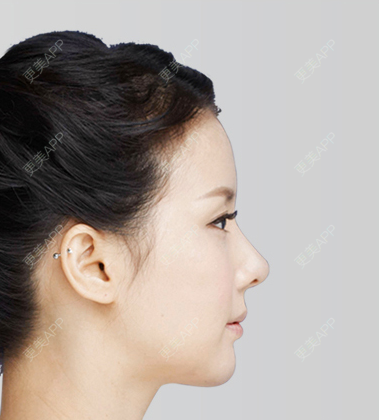 更美 - 王洪勇 医生的自体脂肪全面部填充经验 | 自体脂肪全面部填充 | 广州