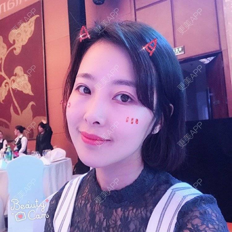 更美 - 于晓云 医生的全切双眼皮经验 | 沈阳 | 全切双眼皮