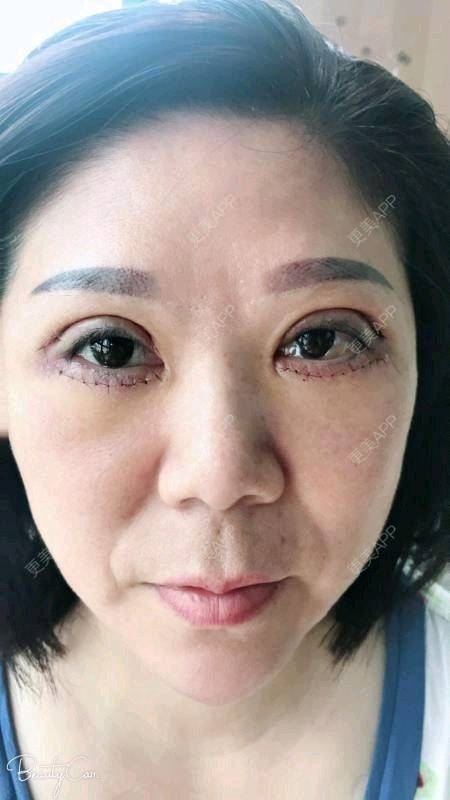年龄不是事儿的外切去眼袋日记