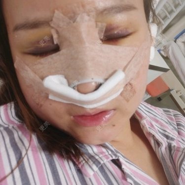 耳软骨隆鼻