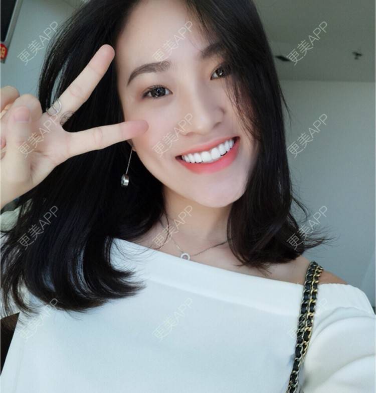 更美 - 更美用户rj0clUUXa5的玻尿酸经验 | 激光淡斑 | 玻尿酸 | 双眼皮 | 广州