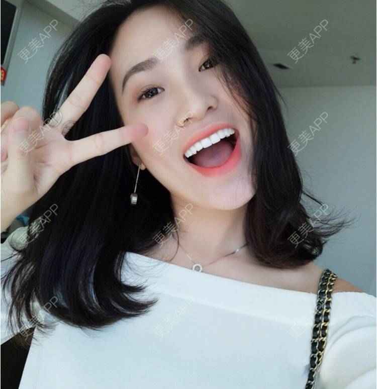 更美 - 更美用户rj0clUUXa5的玻尿酸经验 | 激光淡斑 | 玻尿酸 | 双眼皮 | 广州