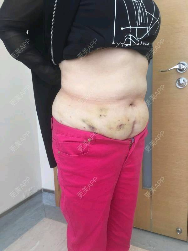 李晓的腰腹吸脂日记