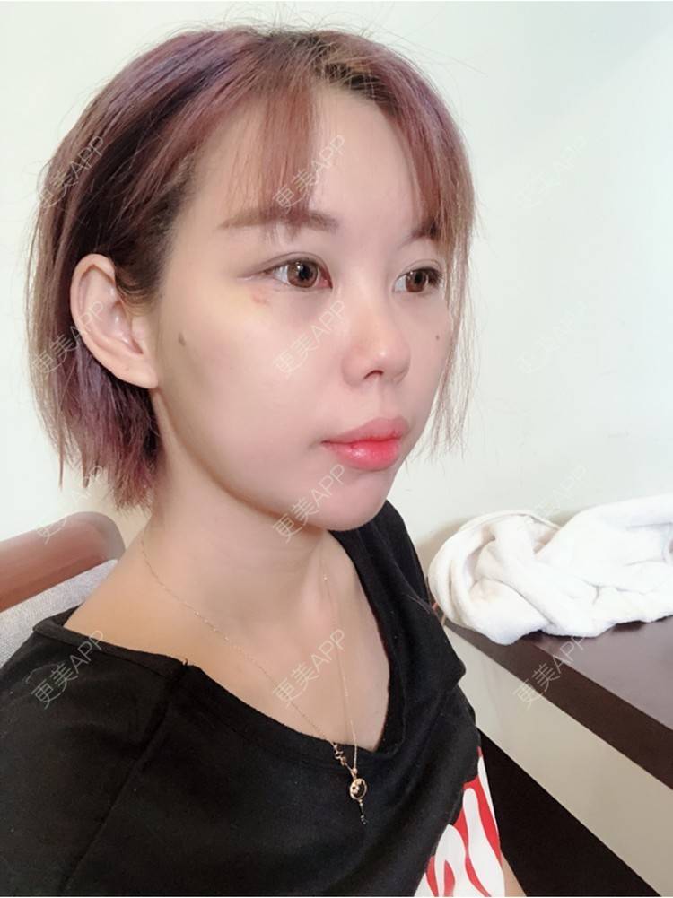 陈碧姬bigi的自体脂肪面部填充日记