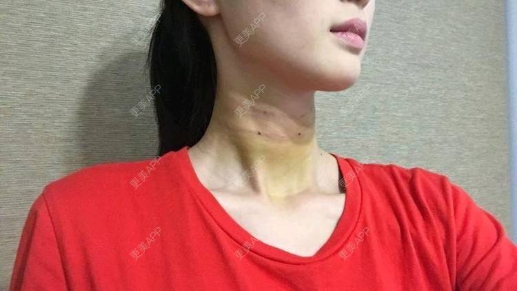 更美 - Annie嵉的自体脂肪填充颈纹经验 | 上海 | 自体脂肪填充颈纹