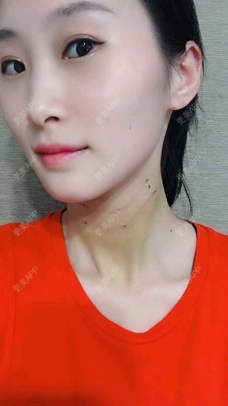 更美 - Annie嵉的自体脂肪填充颈纹经验 | 上海 | 自体脂肪填充颈纹
