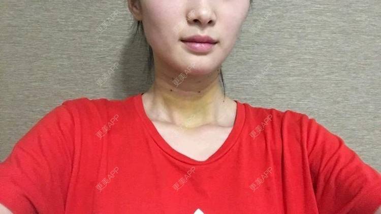 更美 - Annie嵉的自体脂肪填充颈纹经验 | 上海 | 自体脂肪填充颈纹