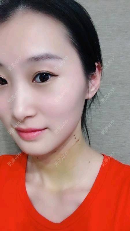 更美 - Annie嵉的自体脂肪填充颈纹经验 | 上海 | 自体脂肪填充颈纹