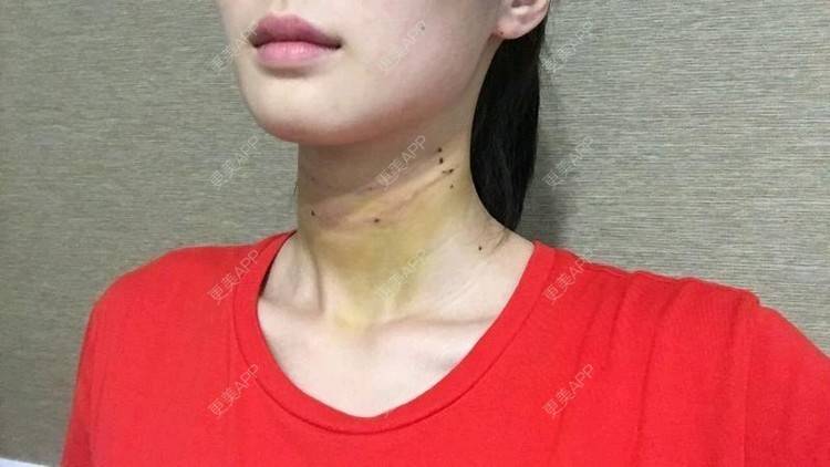 更美 - Annie嵉的自体脂肪填充颈纹经验 | 上海 | 自体脂肪填充颈纹