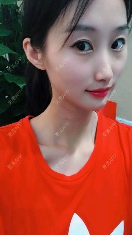 更美 - Annie嵉的自体脂肪填充颈纹经验 | 上海 | 自体脂肪填充颈纹