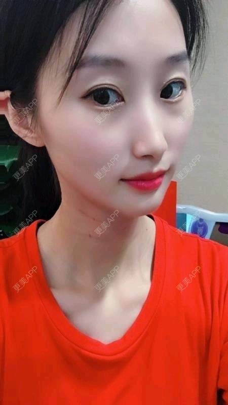 更美 - Annie嵉的自体脂肪填充颈纹经验 | 上海 | 自体脂肪填充颈纹