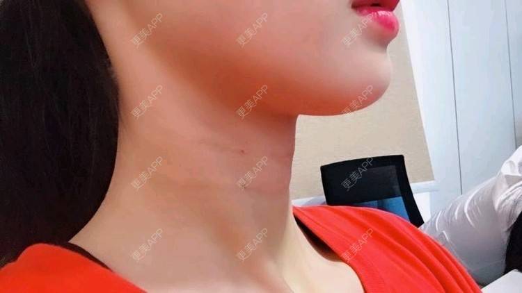 更美 - Annie嵉的自体脂肪填充颈纹经验 | 上海 | 自体脂肪填充颈纹