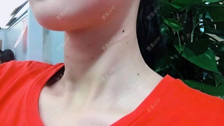 更美 - Annie嵉的自体脂肪填充颈纹经验 | 上海 | 自体脂肪填充颈纹