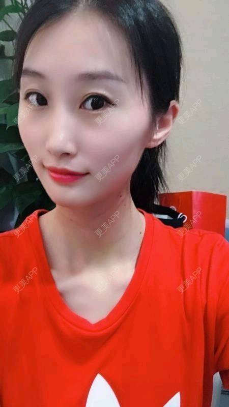 更美 - Annie嵉的自体脂肪填充颈纹经验 | 上海 | 自体脂肪填充颈纹