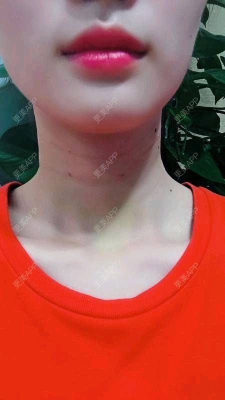 更美 - Annie嵉的自体脂肪填充颈纹经验 | 上海 | 自体脂肪填充颈纹