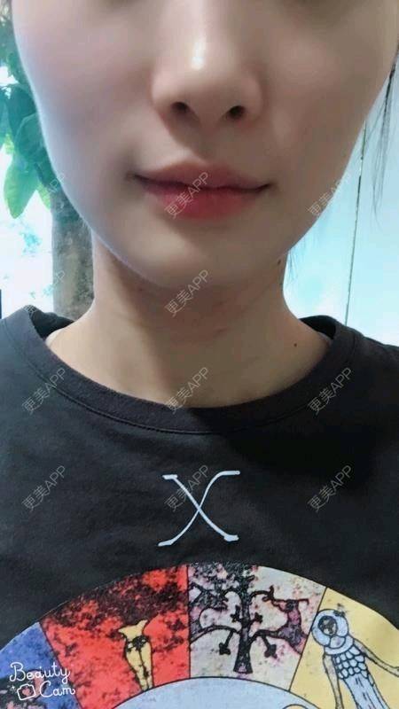 更美 - Annie嵉的自体脂肪填充颈纹经验 | 上海 | 自体脂肪填充颈纹