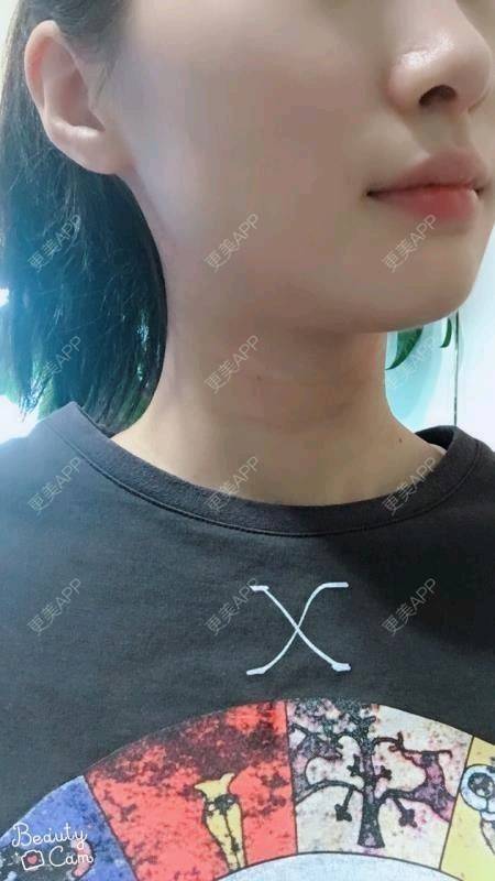 更美 - Annie嵉的自体脂肪填充颈纹经验 | 上海 | 自体脂肪填充颈纹
