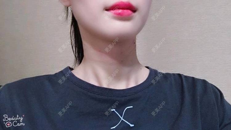 更美 - Annie嵉的自体脂肪填充颈纹经验 | 上海 | 自体脂肪填充颈纹