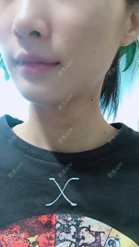 更美 - Annie嵉的自体脂肪填充颈纹经验 | 上海 | 自体脂肪填充颈纹