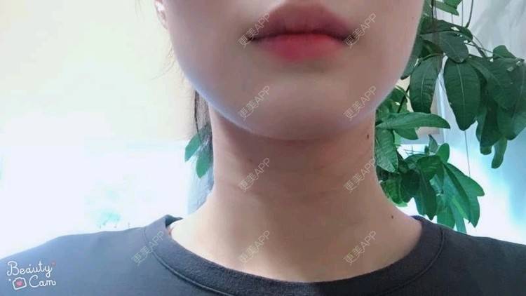 更美 - Annie嵉的自体脂肪填充颈纹经验 | 上海 | 自体脂肪填充颈纹