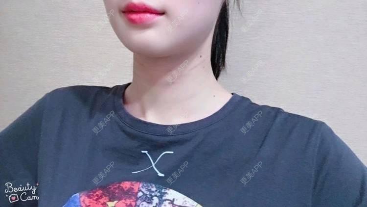 更美 - Annie嵉的自体脂肪填充颈纹经验 | 上海 | 自体脂肪填充颈纹