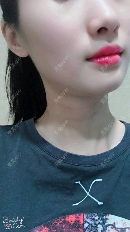 更美 - Annie嵉的自体脂肪填充颈纹经验 | 上海 | 自体脂肪填充颈纹
