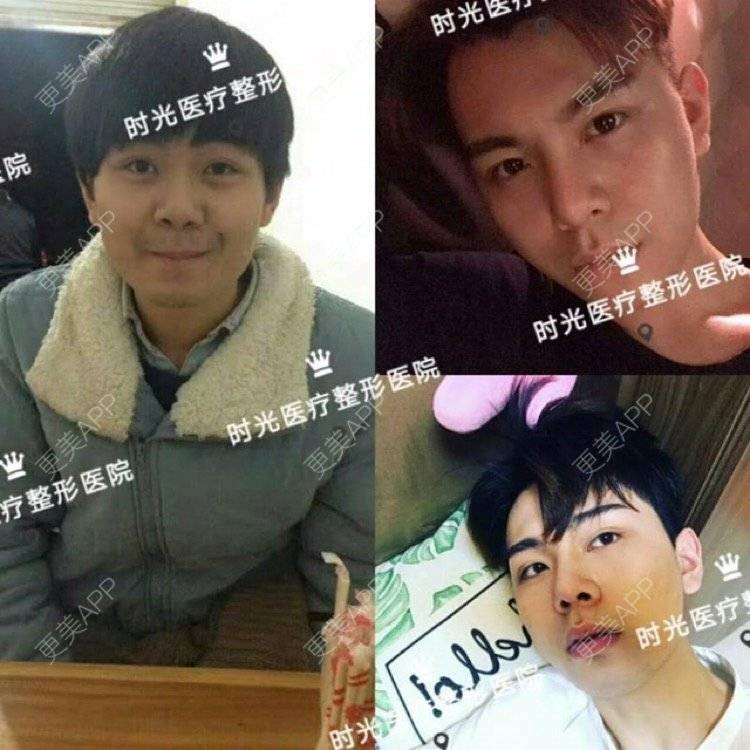 更美 - 南昌时光医疗美容门诊部的隆鼻经验 | 南昌 | 视频日记 | 隆鼻