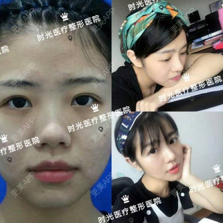 更美 - 南昌时光医疗美容门诊部的隆鼻经验 | 南昌 | 视频日记 | 隆鼻